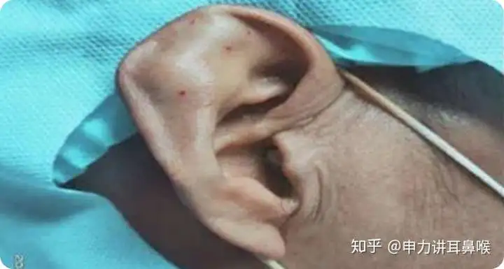 耳朵有包(耳朵有包说明什么原因)